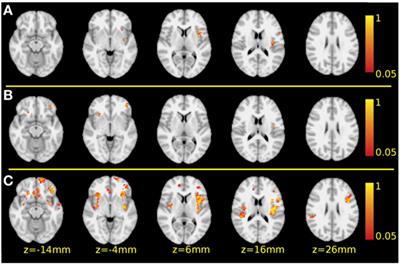 A New Division of Schizophrenia Revealed Expanded Bilateral Brain Structural Abnormalities of the Association Cortices